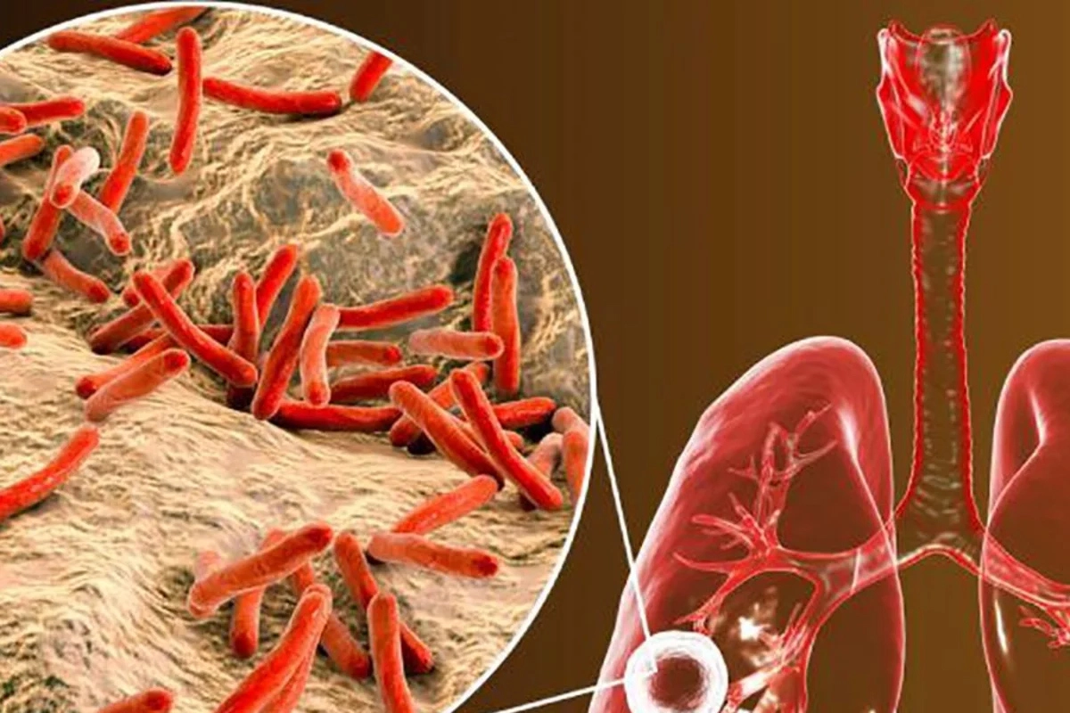 Tuberculosis