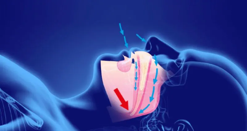 apnea-del-suenoabarca